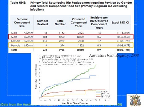 Table of Revision rate for Hip Resurfacing, stratified by size of component and Gender