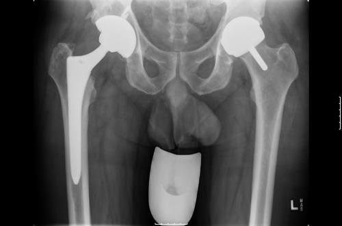 X-Ray of Hip Surgery